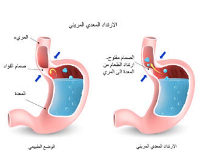 حرقة المعدة