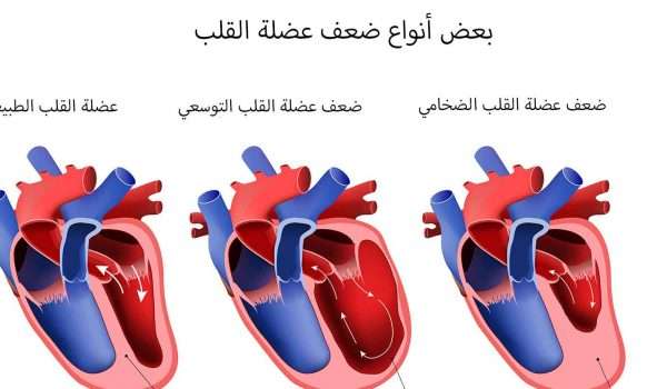 ما هو علاج ضعف عضلة القلب وأعراضها والوقاية منها